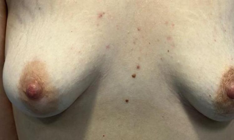 ¿Mama tuberosa mal corregida? - 81289