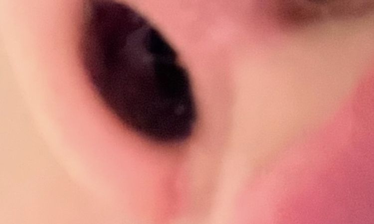 Otorrino o cirujano que aplique corticoides post rinoplastia en Madrid - 81330