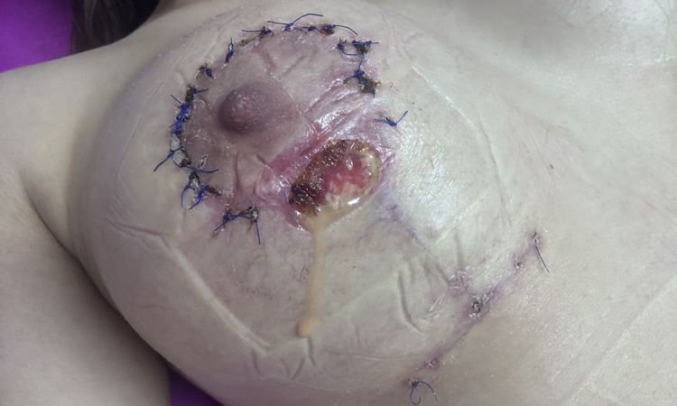 ¿Mastopexia supurando? - 81349