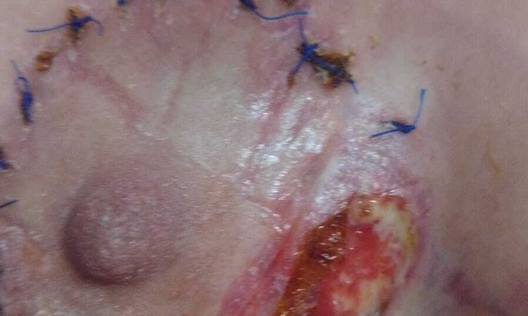 ¿Mastopexia supurando? - 81350