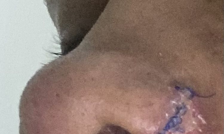 Alectomia nasal plaquitas blancas alrededor de los puntos. - 81400