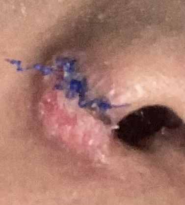 Alectomia nasal plaquitas blancas alrededor de los puntos. - 81401