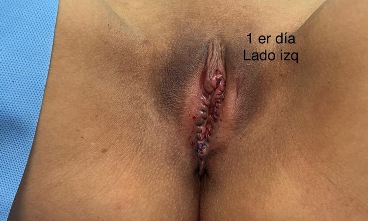 Dudas sobre mi  labioplastia - 81409