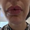 Labios arrugados tras hialuronidasa