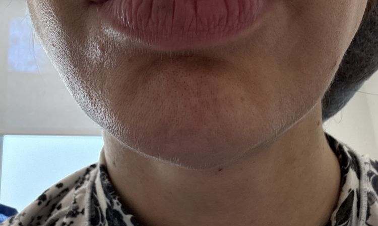 Labios arrugados tras hialuronidasa - 81472