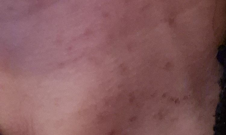 Quemadura HIFU facial - 81484