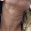 Quemadura HIFU facial
