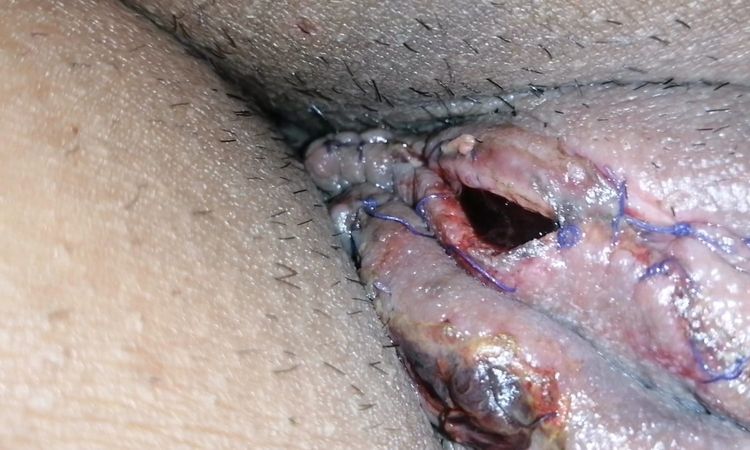 Se abrieron puntos de la labioplastia - 81531