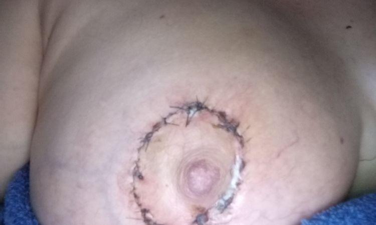 Cicatriz de aureola lastimada después de sacar puntos - 81547