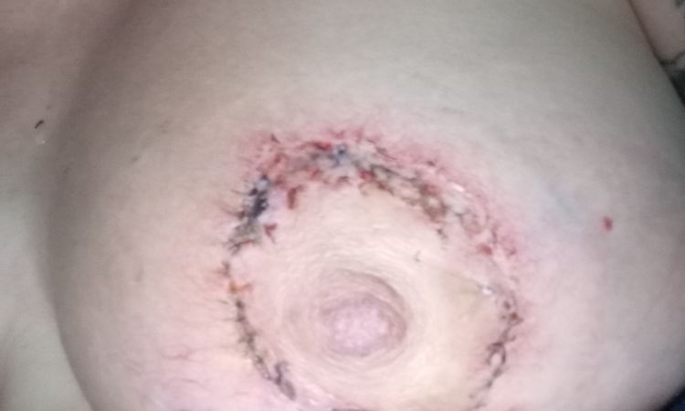 Cicatriz de aureola lastimada después de sacar puntos - 81548
