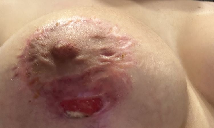Mastopexia con problema - 81569