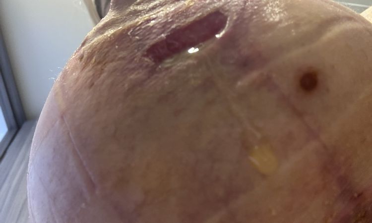 Mastopexia con problema - 81570