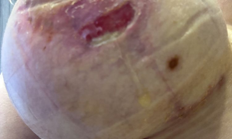 Mastopexia con problema - 81571
