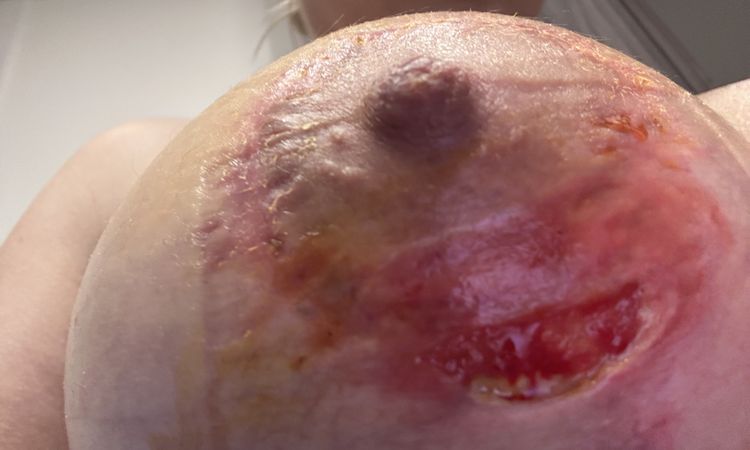 Mastopexia con problema - 81572