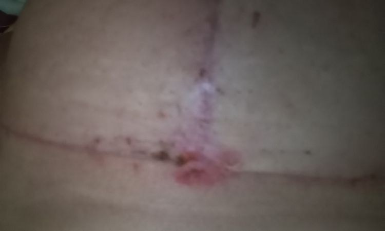 Un punto se reventó y me quedo un parte dentro del seno - 81632