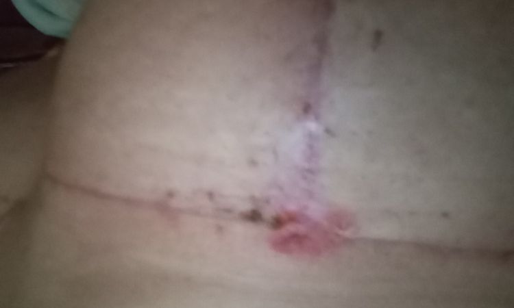 Un punto se reventó y me quedo un parte dentro del seno - 81633