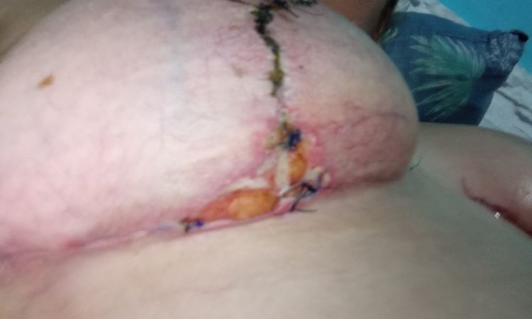25 días de maxopexia y mi cicatriz no cierra después de seroma . - 81650