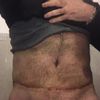 Me sale piel por encima de la cicatriz de abdominoplastía
