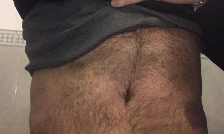 Me sale piel por encima de la cicatriz de abdominoplastía - 81676