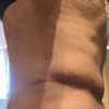 Me sale piel por encima de la cicatriz de abdominoplastía