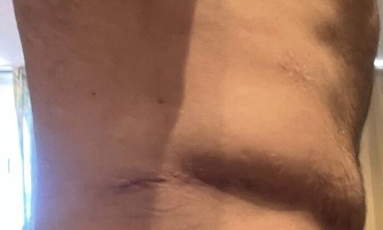 Me sale piel por encima de la cicatriz de abdominoplastía - 81678