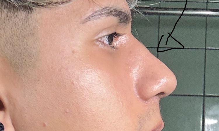 Se me está hundiendo la nariz tras rinoplastia - 81743