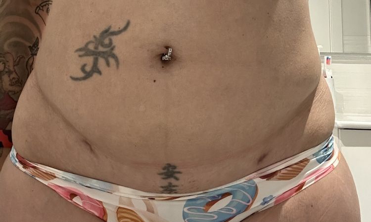 ¿Puede ser inflamación intestinal como dice mi doctora? - 81843
