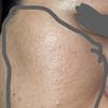 Masa por hidroxiapatita de calcio (bioestimulador)