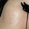 Masa por hidroxiapatita de calcio (bioestimulador)