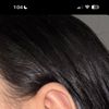 Pliegues en concha  otoplastia