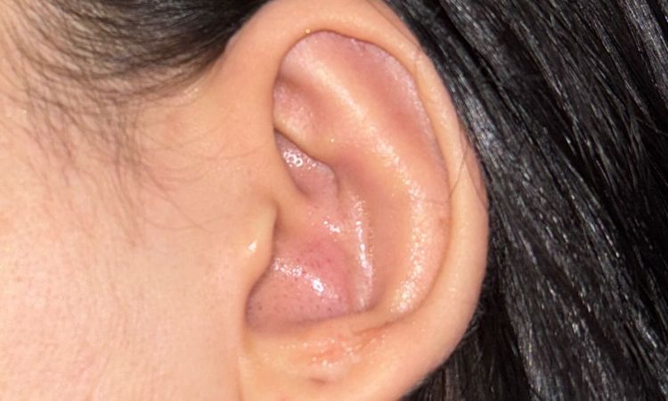 Pliegues en concha  otoplastia - 82050
