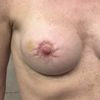 Pliegues luego de mastopexia periareolar