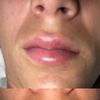 Mañana hace una semana que me pinché los labios