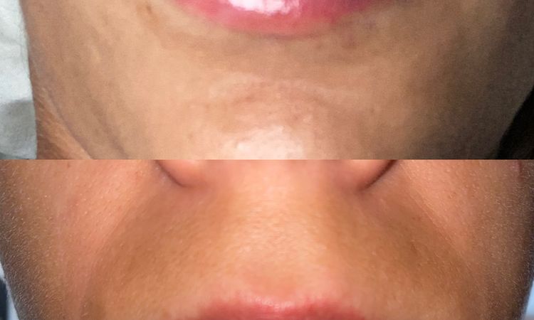 Mañana hace una semana que me pinché los labios - 82136