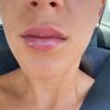 Mañana hace una semana que me pinché los labios