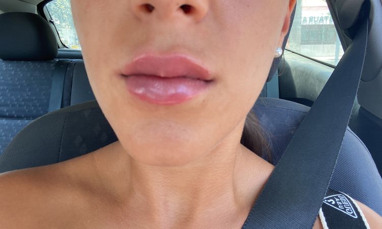 Mañana hace una semana que me pinché los labios - 82137