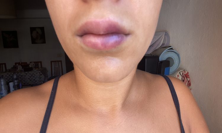 Mañana hace una semana que me pinché los labios - 82138