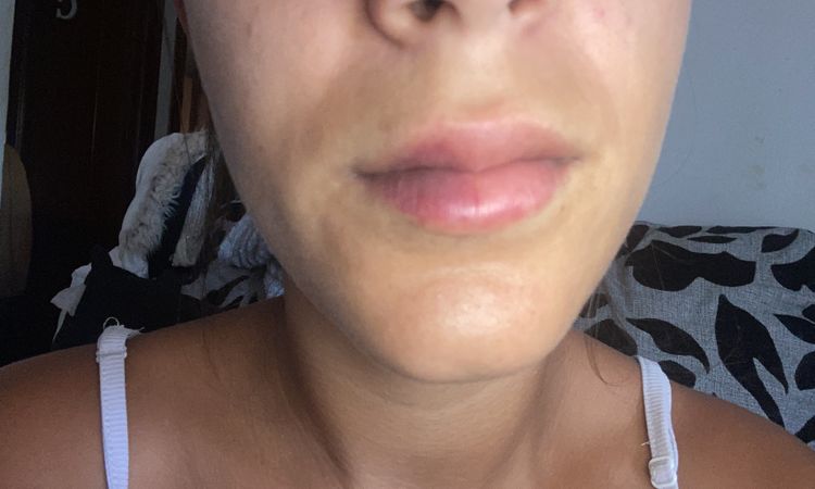 Mañana hace una semana que me pinché los labios - 82140