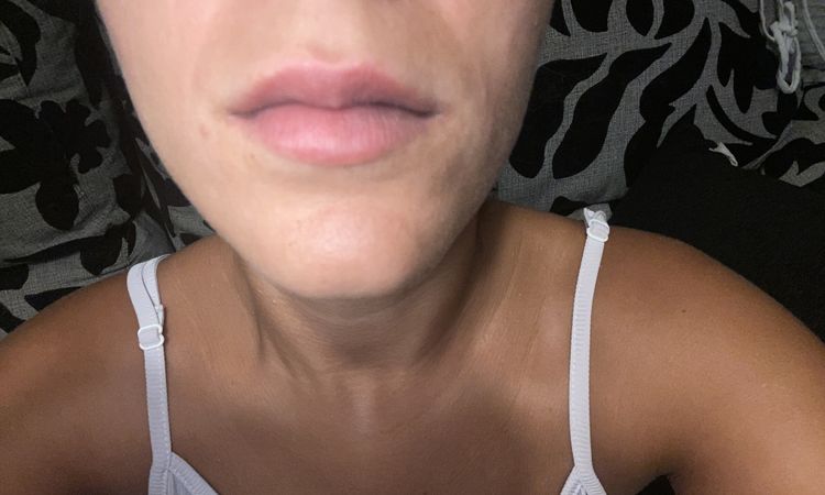 Mañana hace una semana que me pinché los labios - 82141
