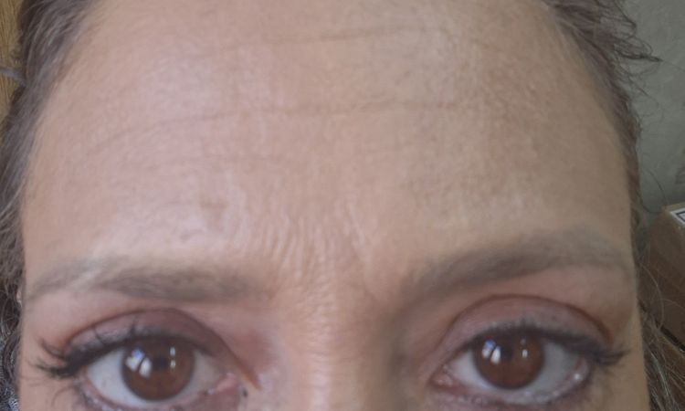Ácido Hialurónico mal colocado en ojeras - 82157