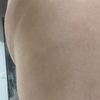 Lipolaser cartucheras sin resultados y con peor apariencia en piernas