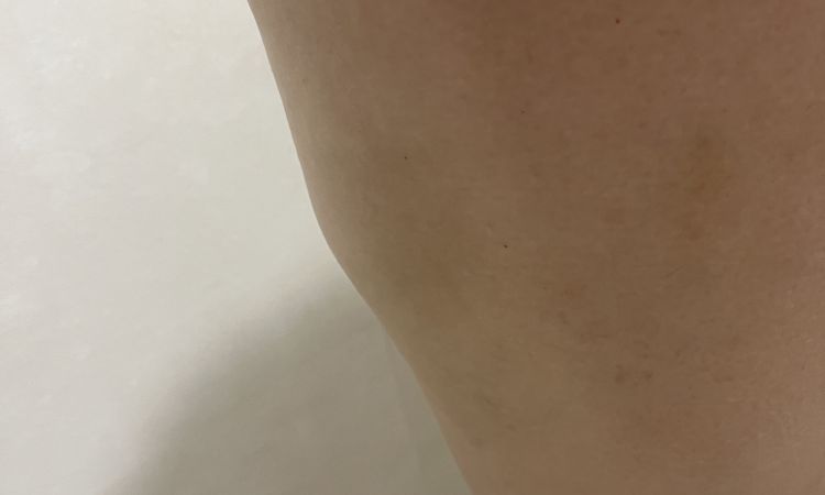 Lipolaser cartucheras sin resultados y con peor apariencia en piernas - 82160