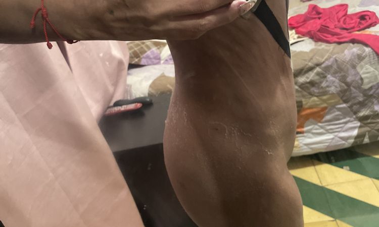 Glúteo se ve igual después de lipotransfer - 82181