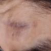 Que tipo de cirugía me deben hacer para eliminar un chichón de la frente