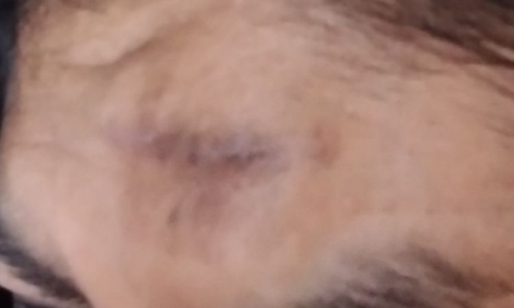 Que tipo de cirugía me deben hacer para eliminar un chichón de la frente - 82204
