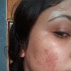 Se notan más mis cicatrices después del fibroblas