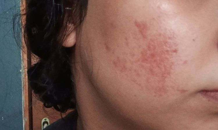 Se notan más mis cicatrices después del fibroblas - 82223