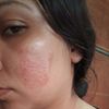 Se notan más mis cicatrices después del fibroblas