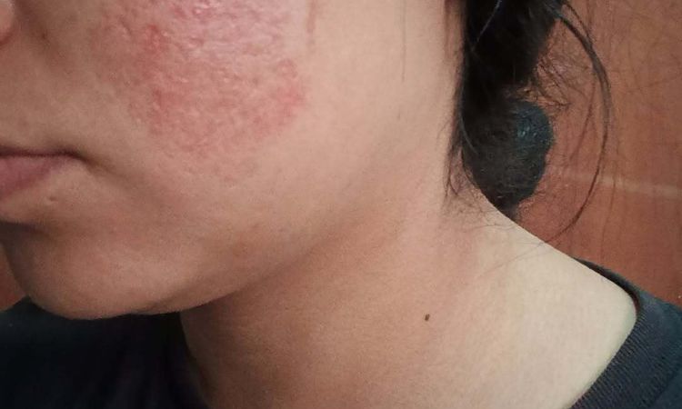 Se notan más mis cicatrices después del fibroblas - 82224