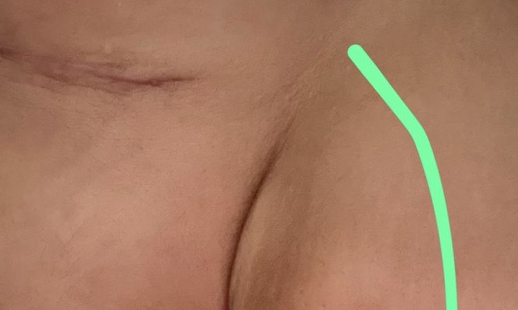 Mastopexia tras dos meses y medio - 82233